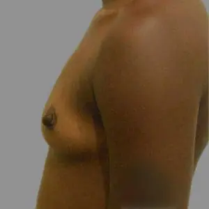 Breast Augmentation Before and After Pictures Charleston, SC