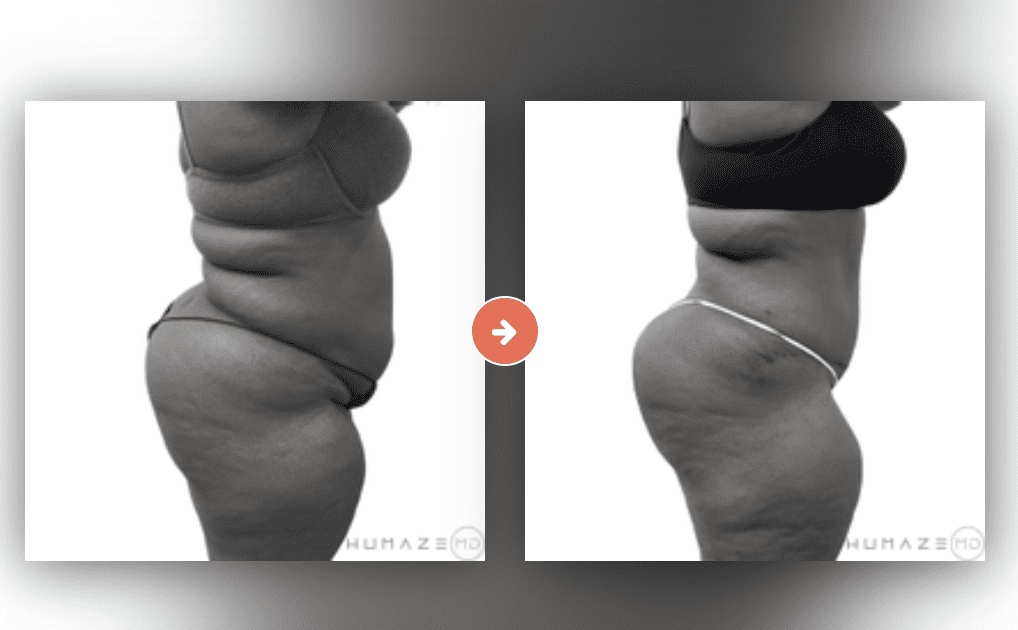 Screenshot 2023-10-12 at 6.54.40 PM Tummy Tuck Before and After Pictures Charleston County, SC