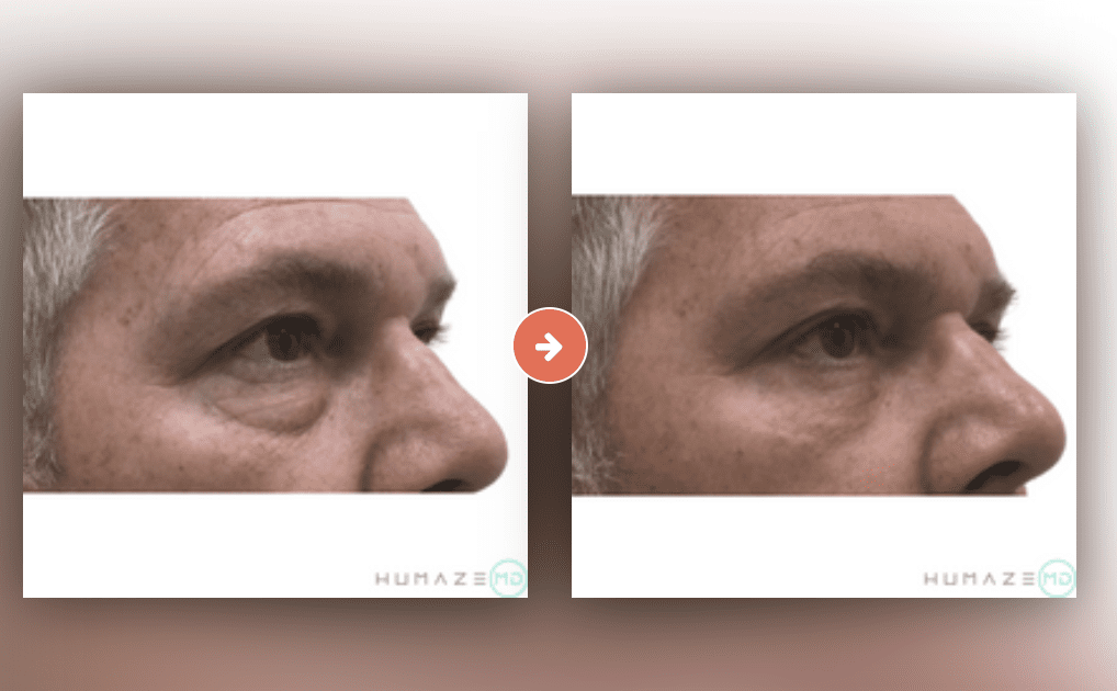 Screenshot 2023-10-12 at 7.09.51 PM Blepharoplasty (Eyelid Surgery) Before and After Pictures Charleston County, SC