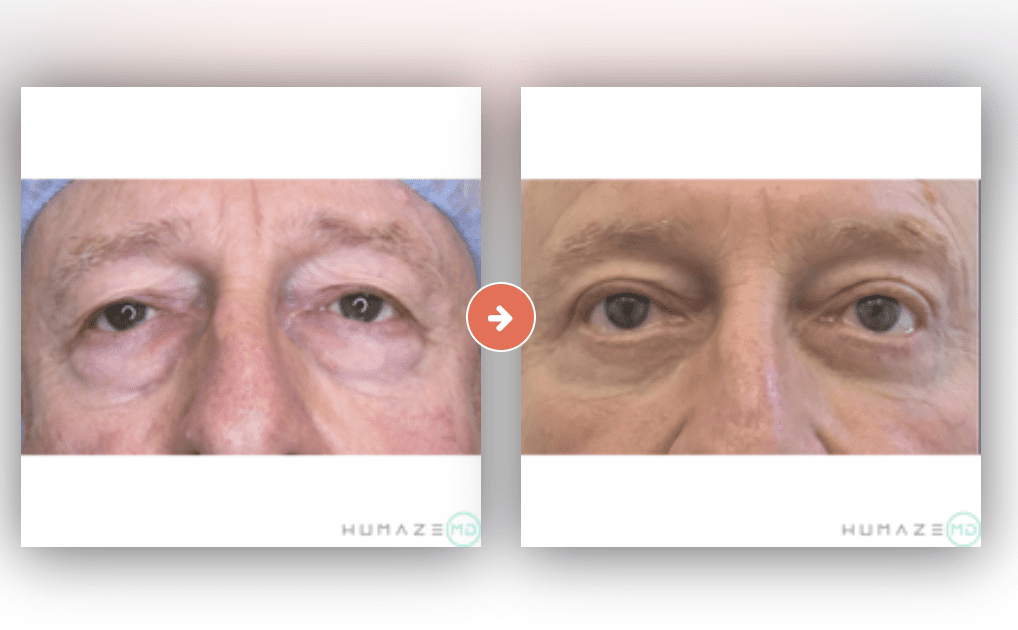 Screenshot 2023-10-12 at 7.10.15 PM Blepharoplasty (Eyelid Surgery) Before and After Pictures Charleston County, SC