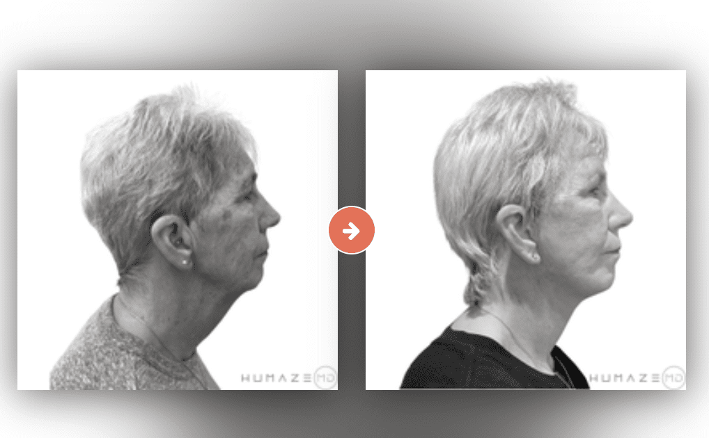 Screenshot 2023-10-12 at 7.11.29 PM Facelift Before and After Pictures Charleston County, SC