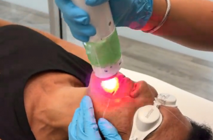 Laser 2 (1) Laser Treatments in Charleston County, SC