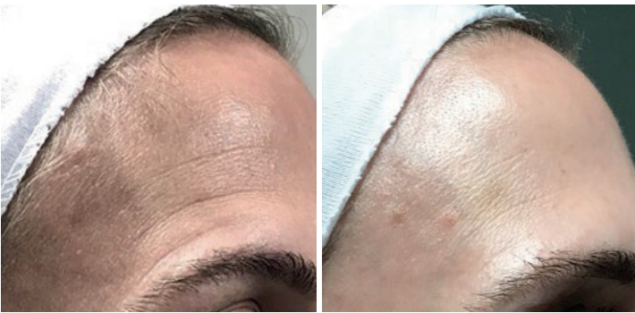 Aerolase Laser Before and After Pictures Charleston County, SC