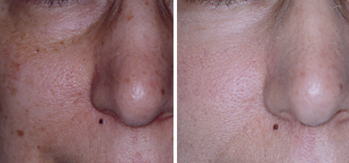 Aerolase Laser Before and After Pictures Charleston County, SC