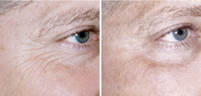 Aerolase Laser Before and After Pictures Charleston County, SC