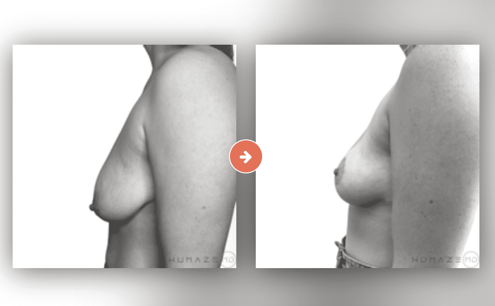 Breast Lift Before and After Pictures Charleston County, SC