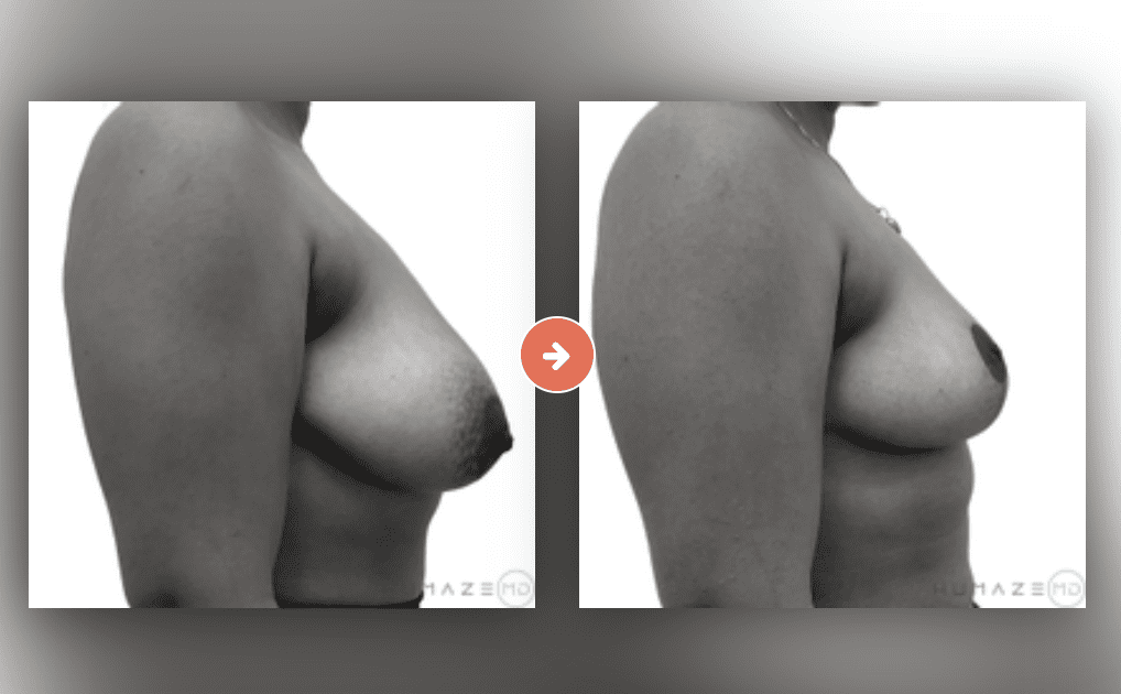Breast Lift Before and After Pictures Charleston County, SC