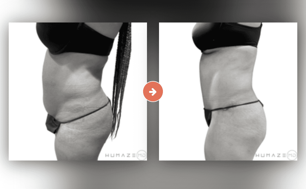 Tummy Tuck Before and After Pictures Charleston County, SC