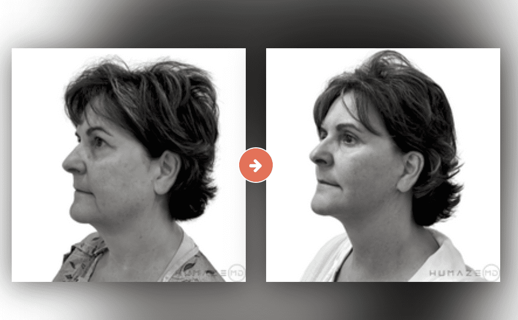 Blepharoplasty (Eyelid Surgery) Before and After Pictures Charleston County, SC