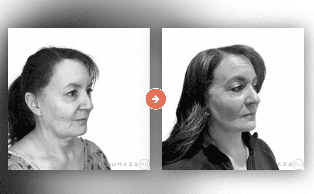 Screenshot 2023-10-12 at 7.11.48 PM Facelift Before and After Pictures Charleston County, SC