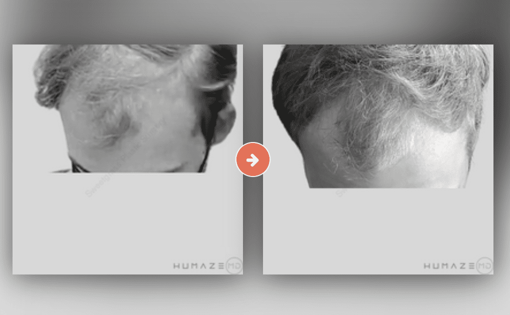 Hair Restoration Before and After Pictures Charleston County, SC