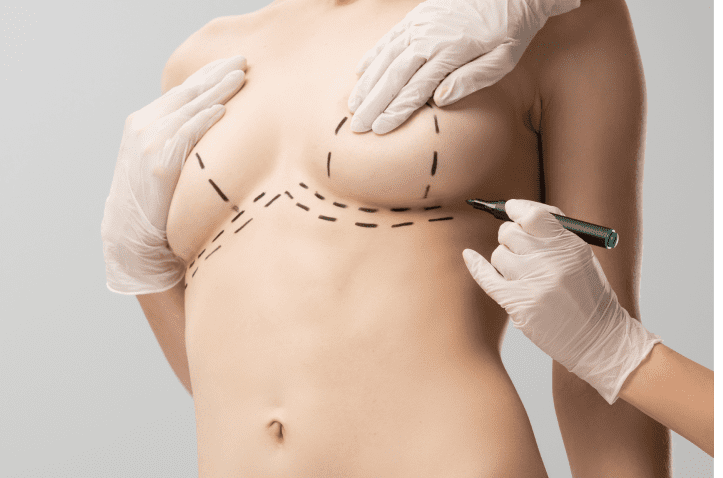 Breast Implant Removal in Charleston County, SC