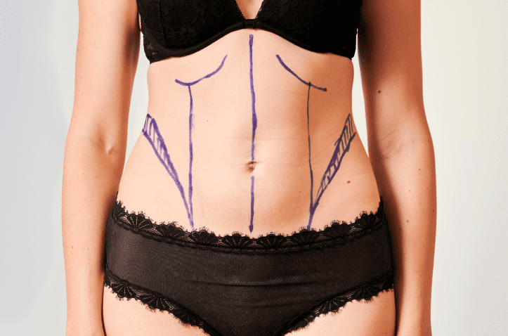 Body Contouring in Charleston County, SC