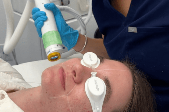 Laser Skin Resurfacing in Charleston County, SC